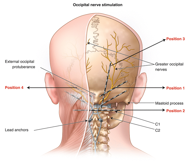 Occipital Nerve Stimulator
